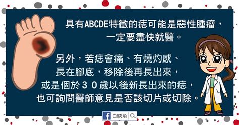 痣變色|我的「痣」會是惡性腫瘤嗎？醫師告訴你：符合這5特。